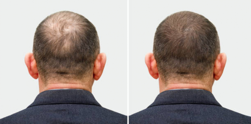 Clínica Que Faz Tratamento para Alopecia Iguatemi - Tratamento para Calvície Salvador