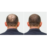 clínica que faz tratamento para alopecia Centro