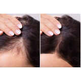 tratamento para alopecia areata Pituba